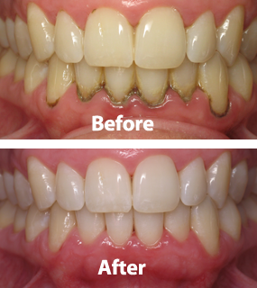 Periodontal-before-after-01.png