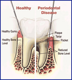 periodontal20Dx20tooth20pic.jpg