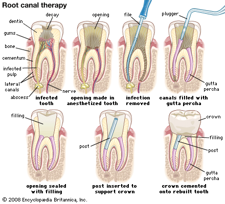 root_canal_therapy.gif